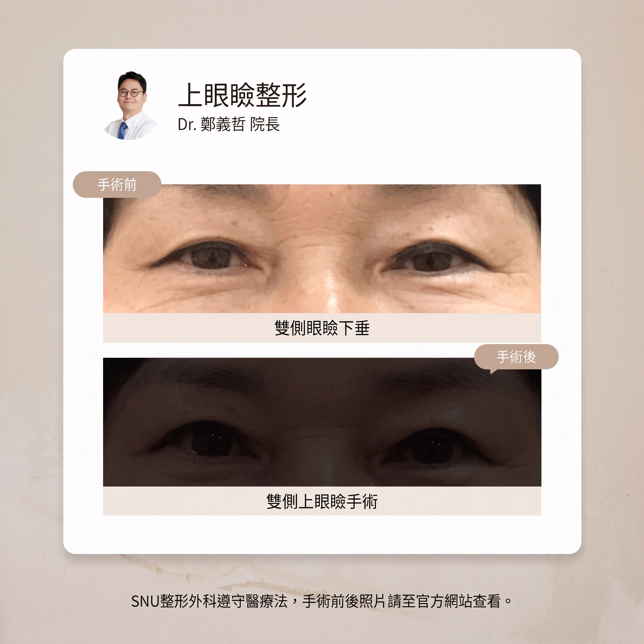 如何矯正眼瞼顫抖現象?清潭洞眼部整形 사진 6