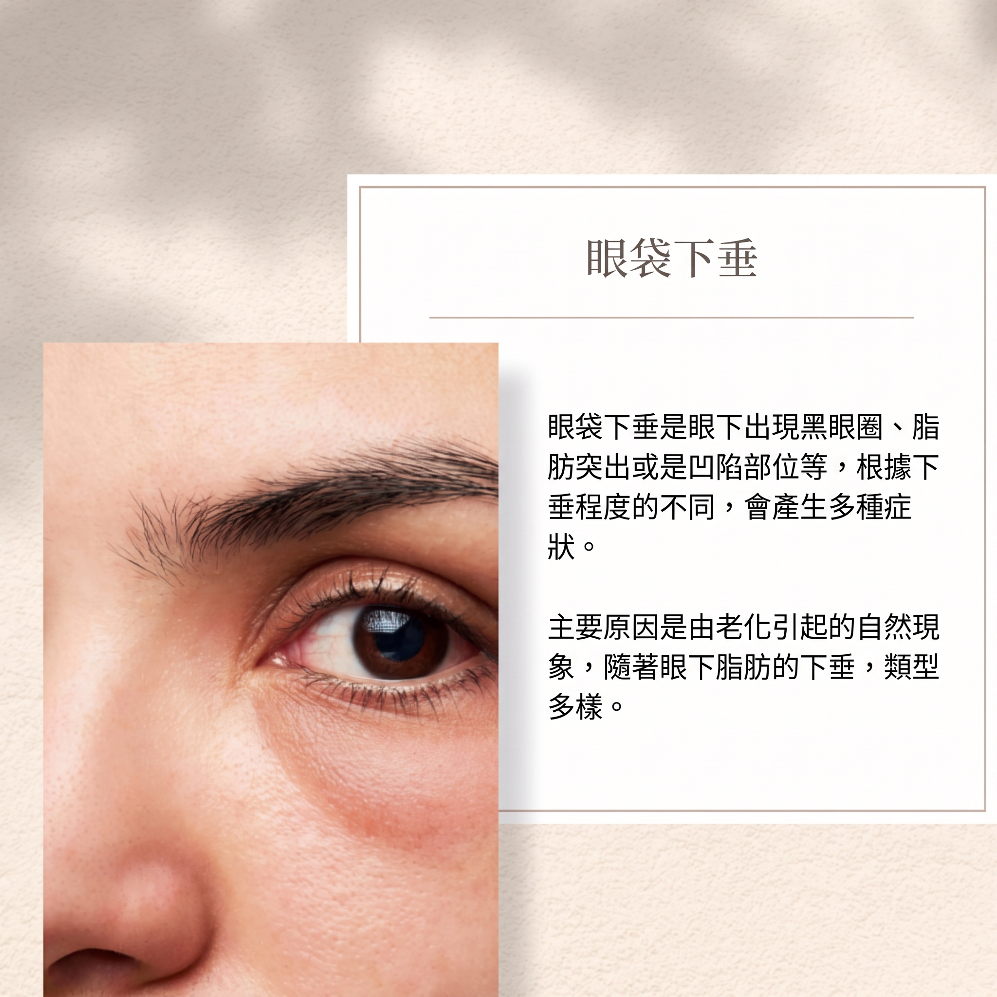 清潭洞眼部整形:如何消除眼下皺紋?