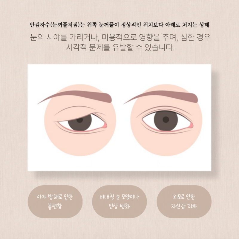 안검하수 잘하는 병원 어디로 가야 할지 못정했다면