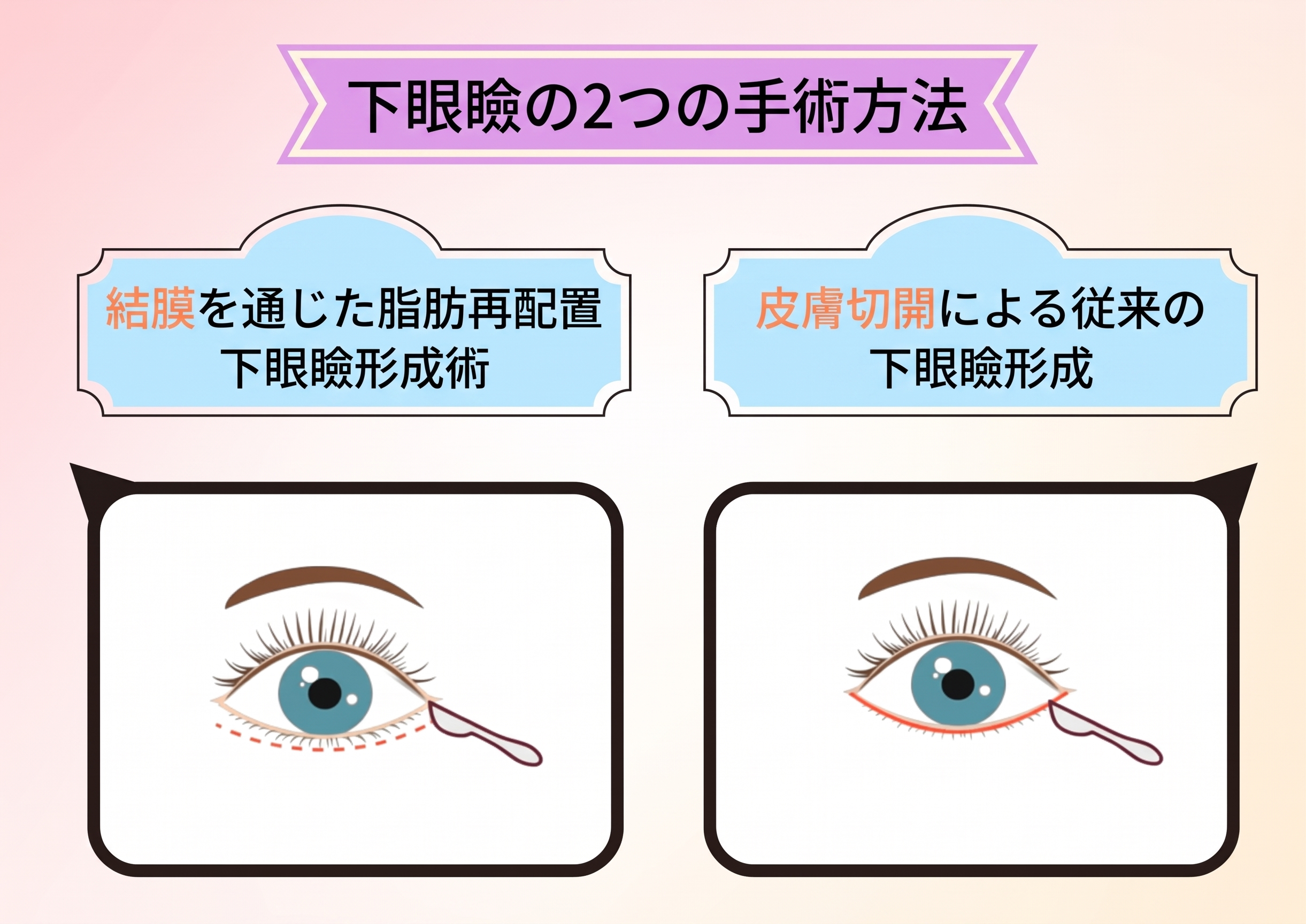 下眼瞼形成術:脂肪再配置VS皮膚切開、どちらを選択すべきか?
