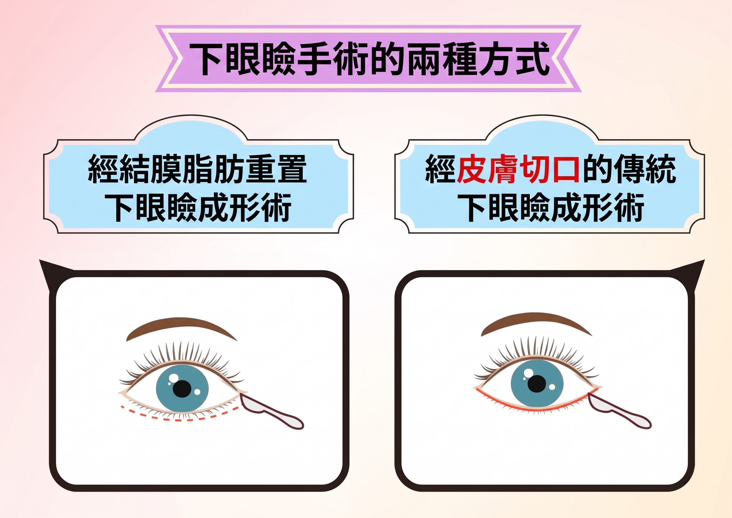 下眼瞼整形手術:脂肪重新分佈 VS 皮膚切開法,該如何選擇?