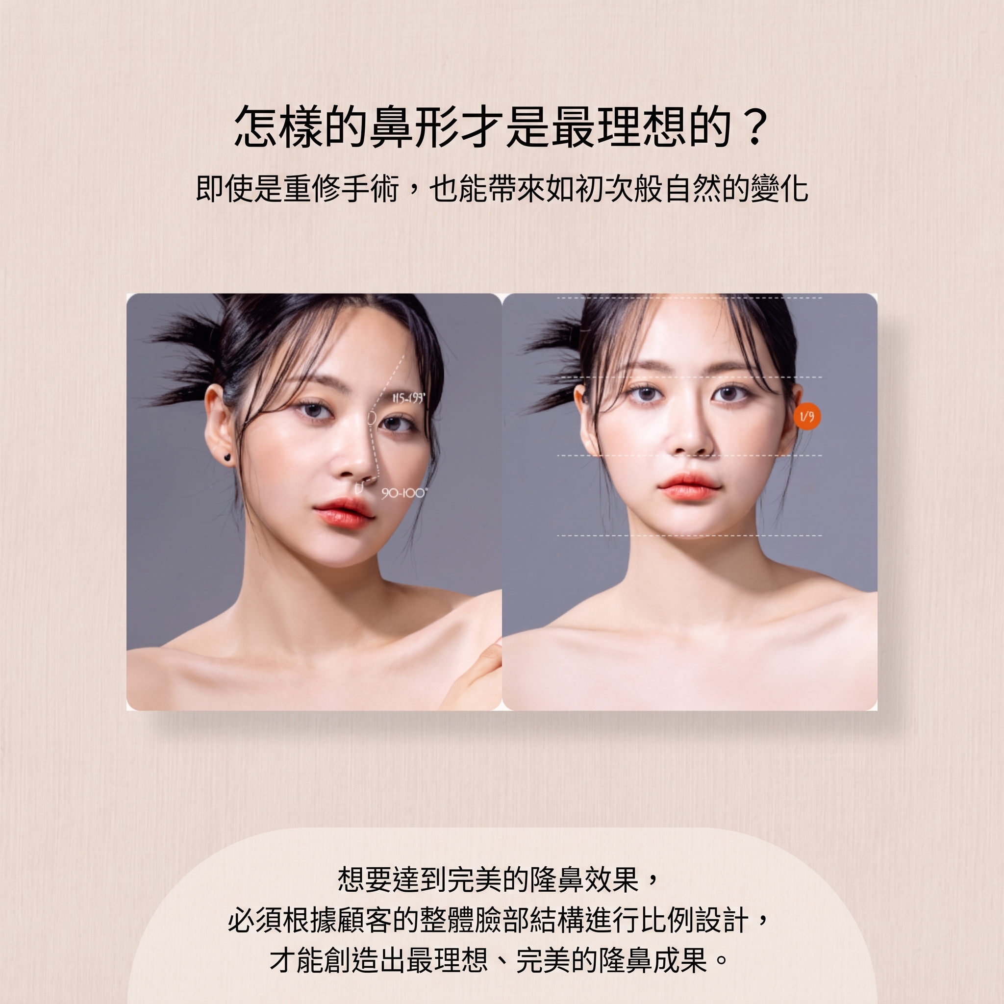 清潭鼻整形:攣縮鼻形成後的再手術方法 사진 5