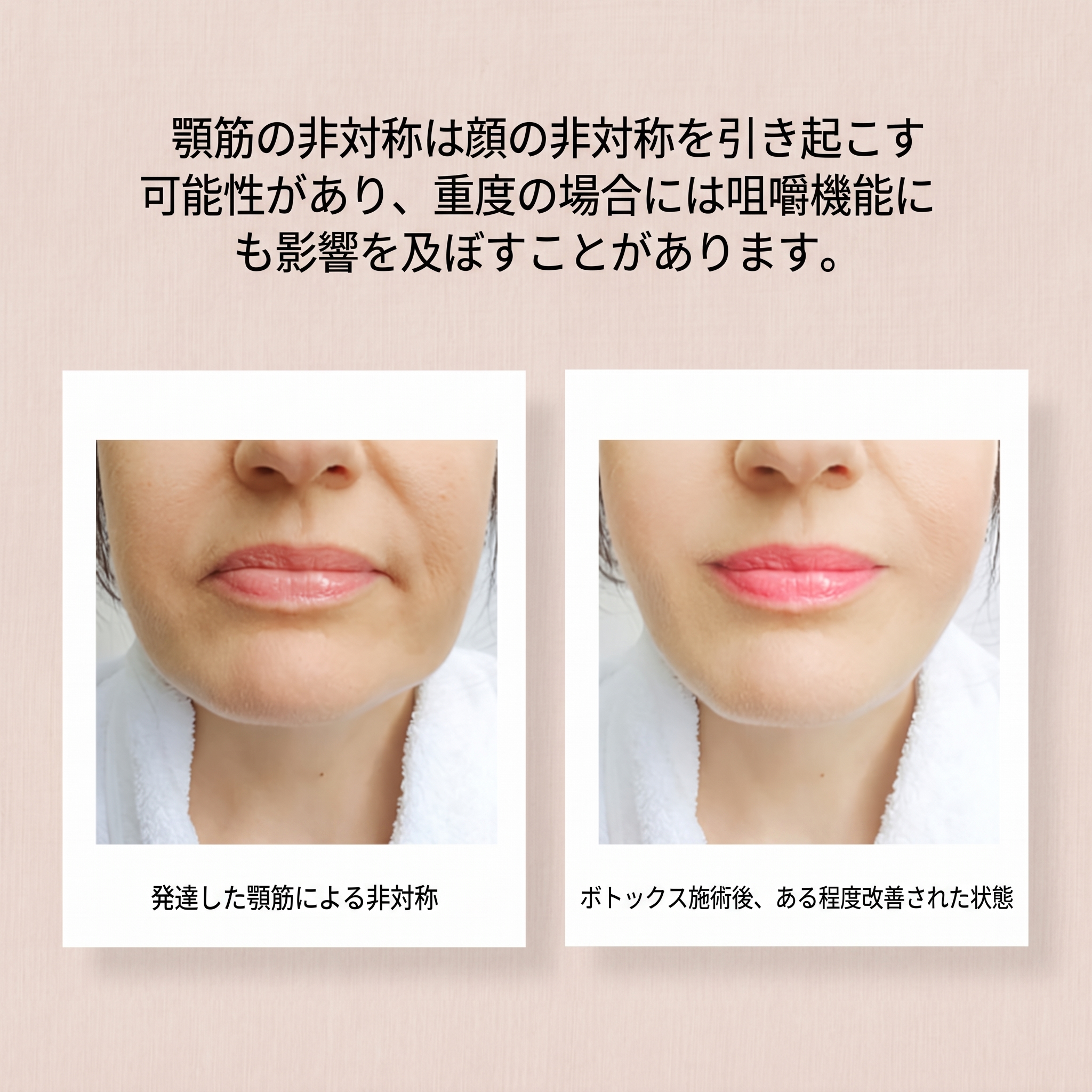 清潭ボトックス 顎の筋肉の非対称に必要なボトックス？ 사진 2