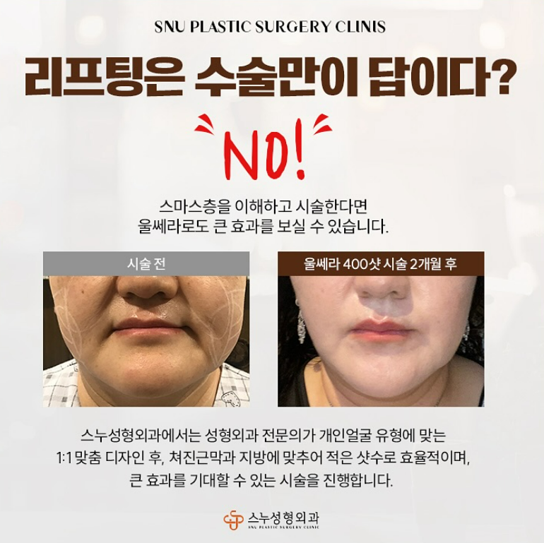 울쎄라와 진정(수면) 마취, 한국과 세계 시술방식의 차이점