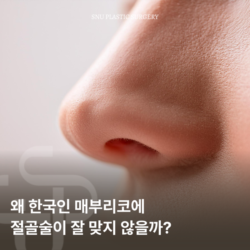 무보형물 매부리코 교정술, 어떤 경우에 적합한가?