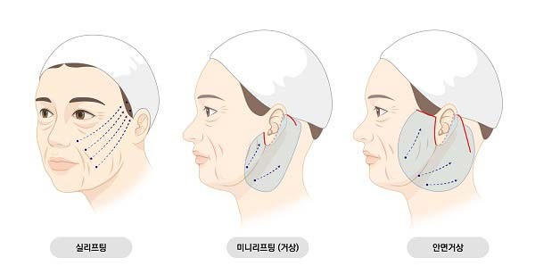 [Phẫu thuật thẩm mỹ SNU] Nâng cơ mặt, khi nào là thời điểm tốt nhất?